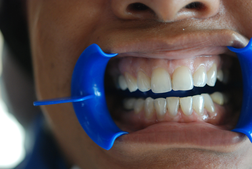 Dental Clinic Before Zoom Teeth Whitening