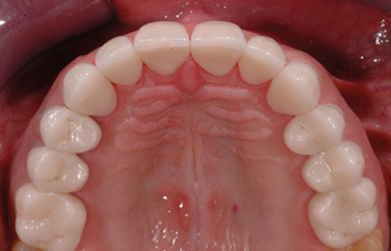 Low Cost Dental Implant in India | Dental Implant Treatment in Delhi