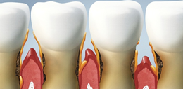 teeth scaling and deap cleaning